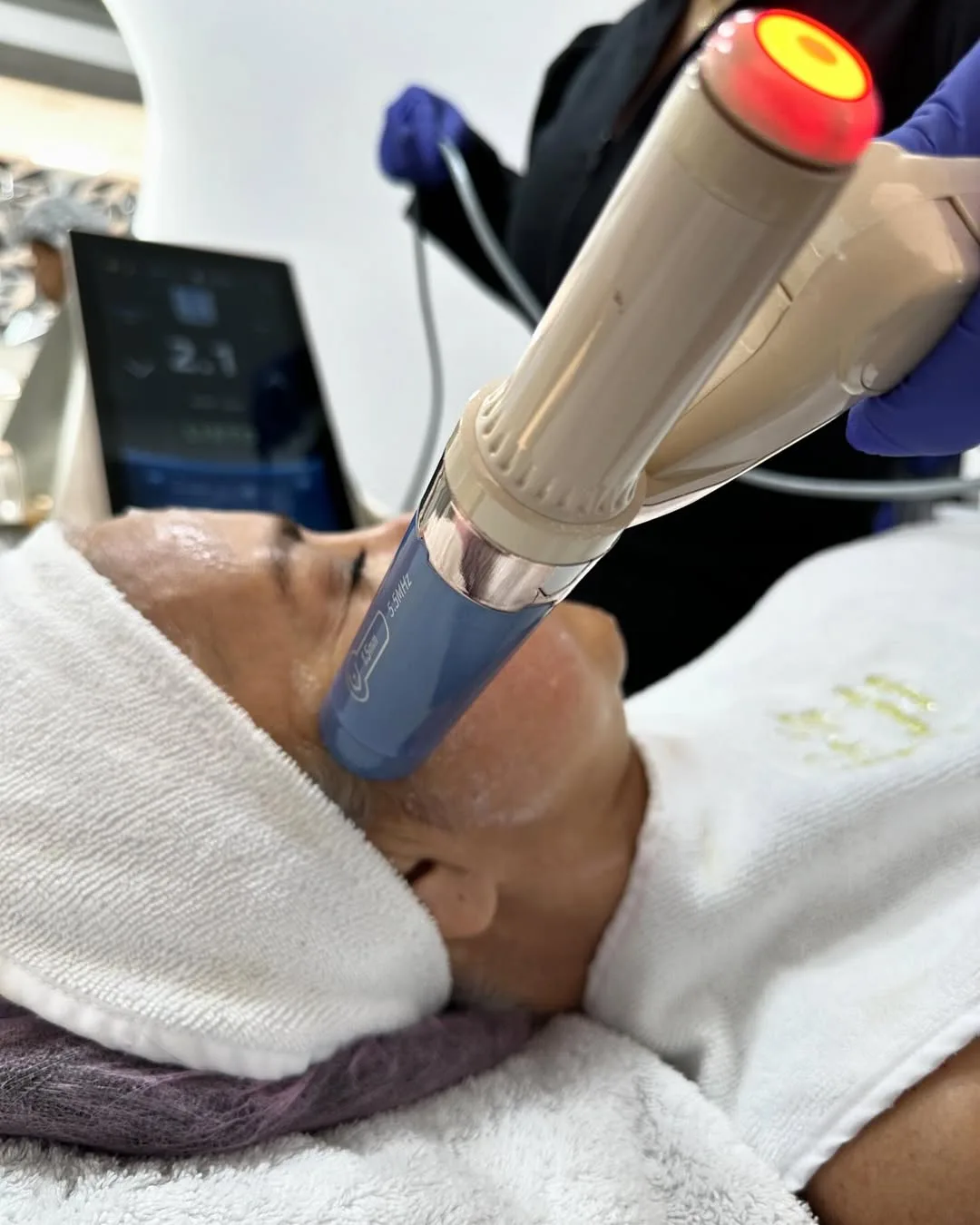 HIFU 22D Max en Spabella Stetic