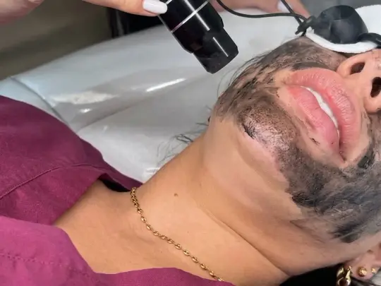 Láser Hollywood Peel en Spabella Stetic