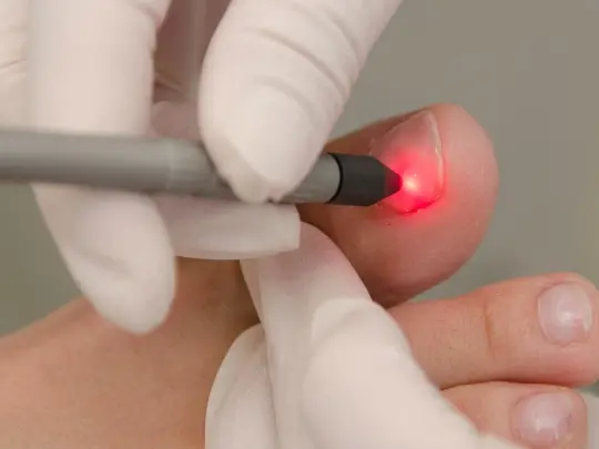 Láser Onicomicosis en Spabella Stetic